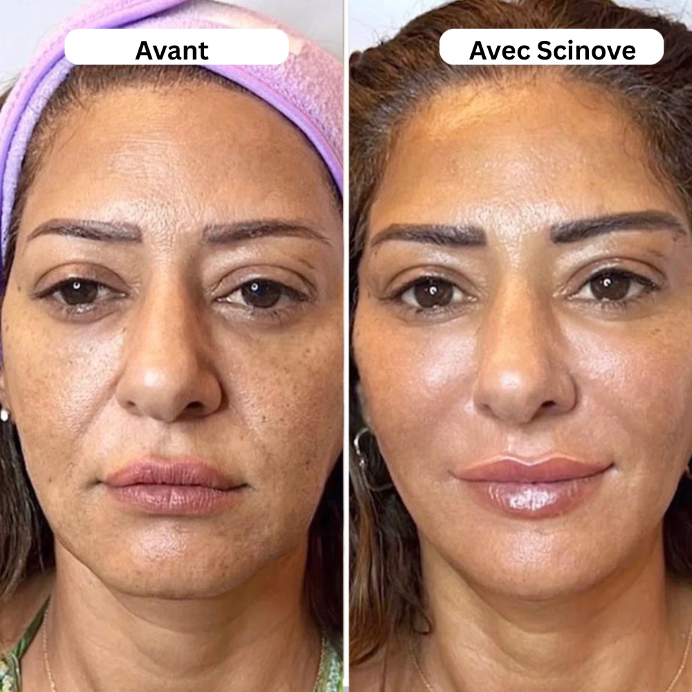 Scinove Micro-Infuseur Pro™